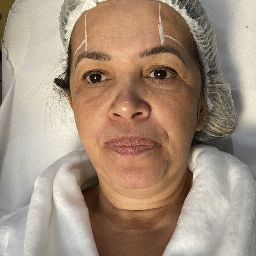Antes — bioestimulador de colágeno