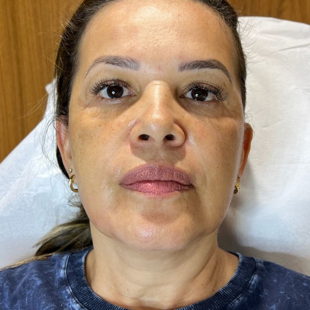 Depois — bioestimulador de colágeno