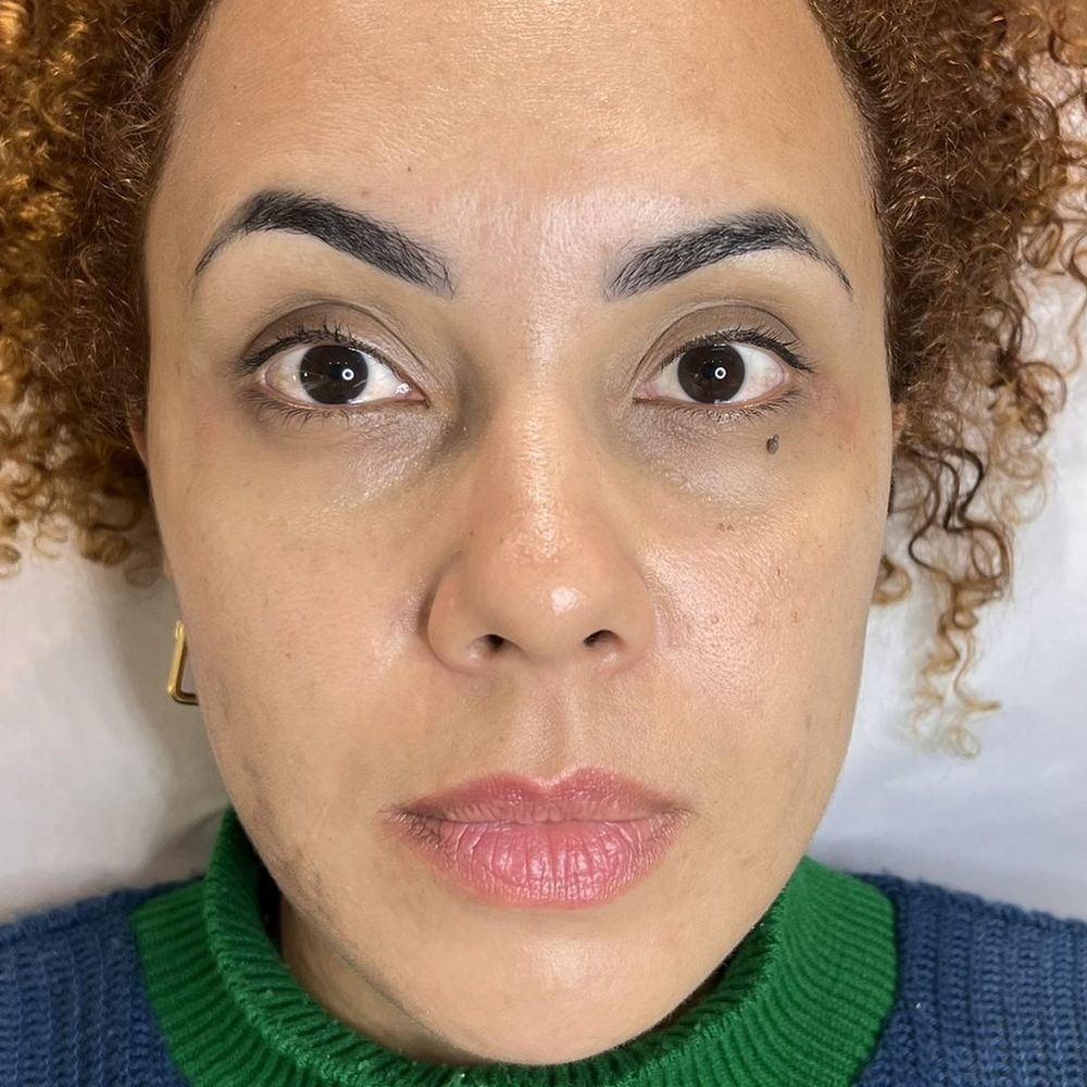 Depois — toxina botulínica