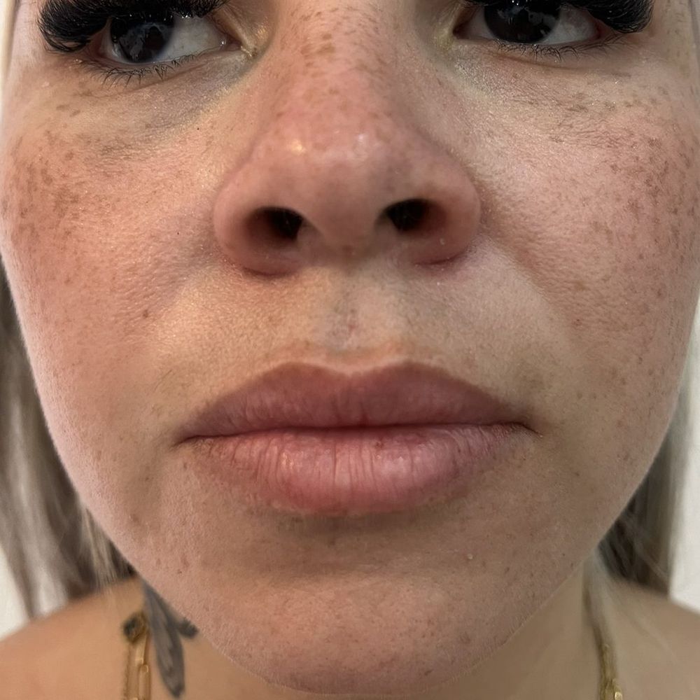 Antes — preenchimento labial